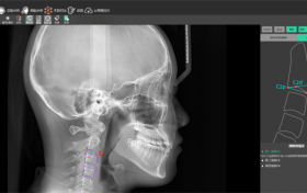 当AI骨龄分析遇见低剂量口腔CT：儿童正畸的双重精准保障